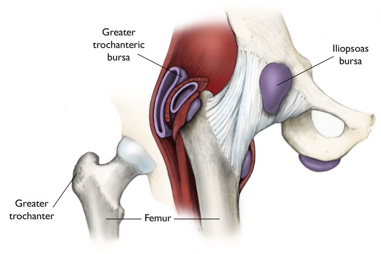 Trochanteric Bursitis and how Pilates & Rebounding helped me.