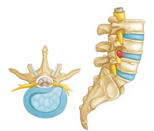 Lumbar spine and disc